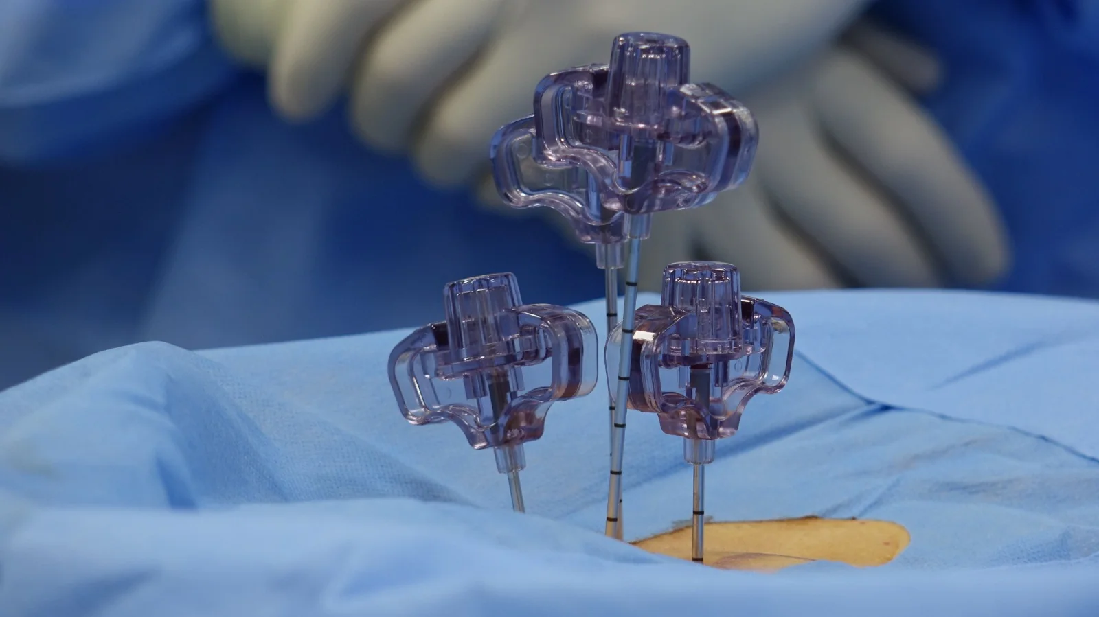 Pedicle screw implants placed during spinal fixation surgery